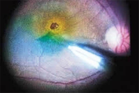 黃斑前膜,黃斑前膜手術,黃斑前膜治療 黃斑前膜,黃斑前膜手術,黃斑前膜治療