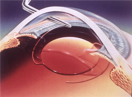 白內障,白內障成因,白內障治療,白內障手術