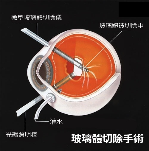 視網膜脫離,視網膜脫落,玻璃體切除手術,視網膜 視網膜脫離,視網膜脫落,玻璃體切除手術,視網膜