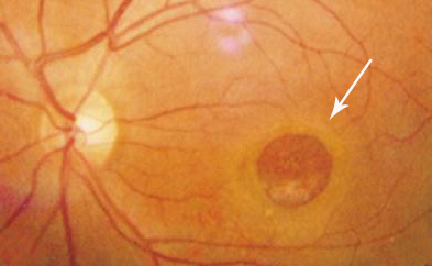 黃斑裂孔,黃斑裂孔診斷,黃斑裂孔治療,黃斑裂孔 黃斑裂孔,黃斑裂孔診斷,黃斑裂孔治療,黃斑裂孔