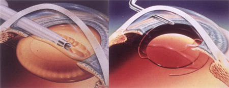 白內障,人工晶體,白內障手術,白內障治療 白內障,人工晶體,白內障手術,白內障治療