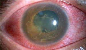 眼底出血,北京眼科醫(yī)院 眼底出血,北京眼科醫(yī)院