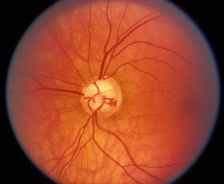 高度近視,青光眼,眼底病變,青光眼癥狀,青光眼治