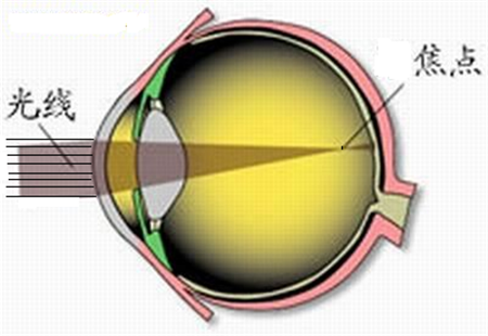 近視,預(yù)防近視,魚眼睛,高度近視,近視防控,延緩近