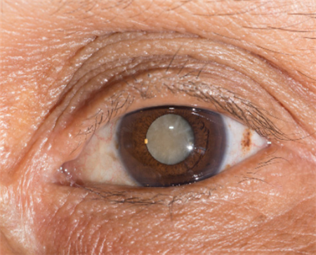 白內障,白內障癥狀 白內障,白內障癥狀