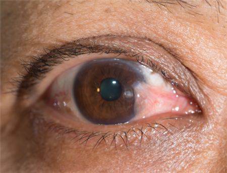 翼狀胬肉,翼狀胬肉手術,翼狀胬肉聯合手術,翼狀