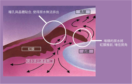青光眼,急性青光眼,青光眼癥狀,青光眼治療 青光眼,急性青光眼,青光眼癥狀,青光眼治療
