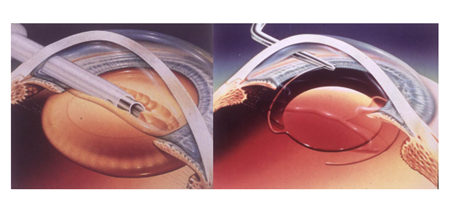 白內(nèi)障,白內(nèi)障癥狀,白內(nèi)障治療,白內(nèi)障手術(shù)