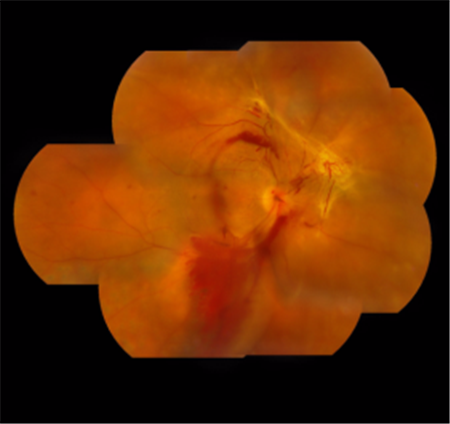 糖網病,糖尿病,視網膜病變,黃斑水腫,視網膜脫離 糖網病,糖尿病,視網膜病變,黃斑水腫,視網膜脫離