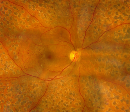 糖網病,糖尿病,視網膜病變,黃斑水腫,視網膜脫離 糖網病,糖尿病,視網膜病變,黃斑水腫,視網膜脫離