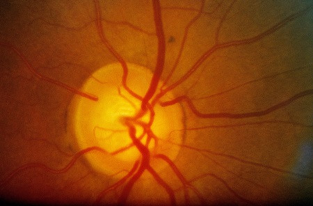 青光眼,先天性青光眼,兒童青光眼,青光眼治療,青