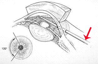 青光眼,先天性青光眼,兒童青光眼,青光眼治療,青