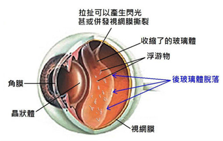 飛蚊癥,玻璃體是什么,飛蚊癥癥狀,飛蚊癥治療,飛 飛蚊癥,玻璃體是什么,飛蚊癥癥狀,飛蚊癥治療,飛