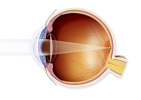 白內障,白內障癥狀,白內障手術,白內障治療 白內障,白內障癥狀,白內障手術,白內障治療