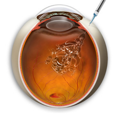 眼底出血,眼表出血,眼底出血治療,玻璃體注射,激