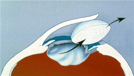 白內障,白內障治療,白內障手術,超聲乳化手術 白內障,白內障治療,白內障手術,超聲乳化手術