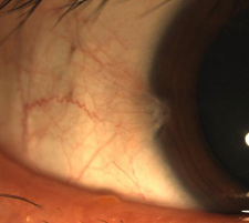 魚肉,翼狀胬肉,手術 魚肉,翼狀胬肉,手術