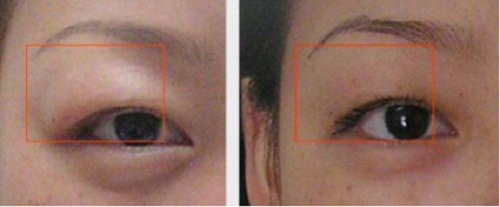 上瞼下垂,眼睛睜不開,腫眼泡