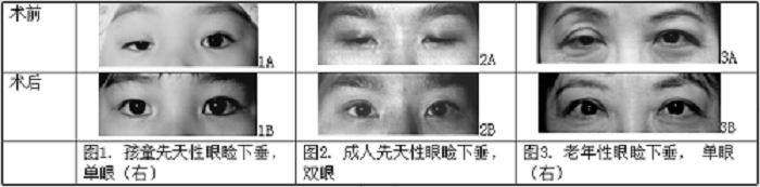 上瞼下垂,眼睛睜不開,腫眼泡