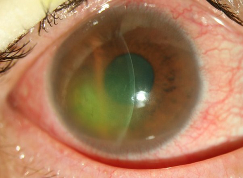 胬肉,角膜損傷,眼角膜,眼表