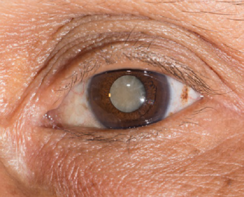 胬肉,角膜損傷,眼角膜,眼表