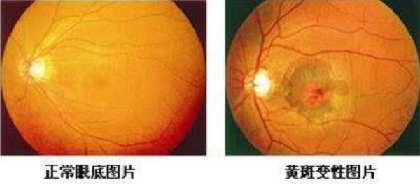 胬肉,角膜損傷,眼角膜,眼表