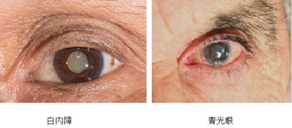 白內(nèi)障,青光眼,晶體變厚 白內(nèi)障,青光眼,晶體變厚