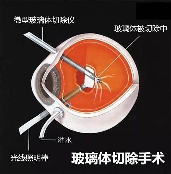 什么,原因,可能,導致,視網膜,脫落,如果,可以, 什么,原因,可能,導致,視網膜,脫落,如果,可以,