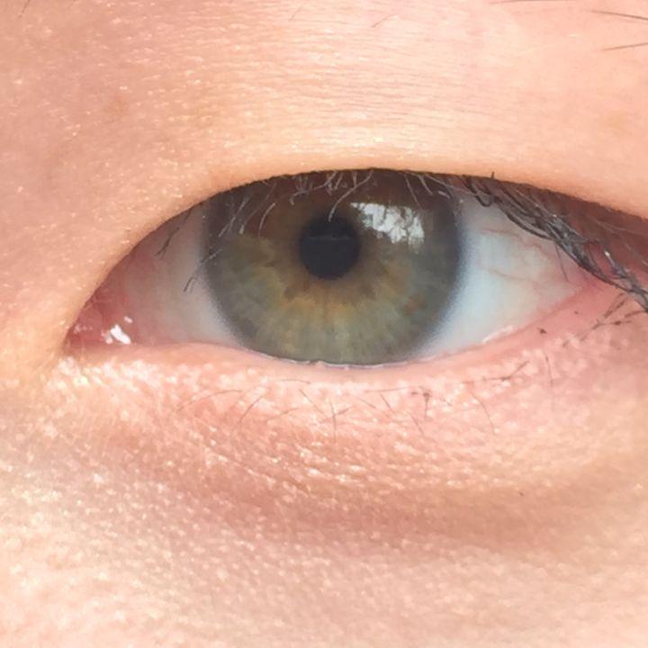 上瞼下垂 上瞼下垂