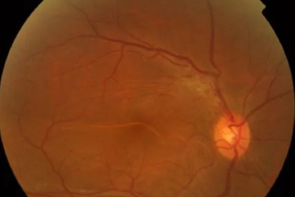 黃斑病變 黃斑病變