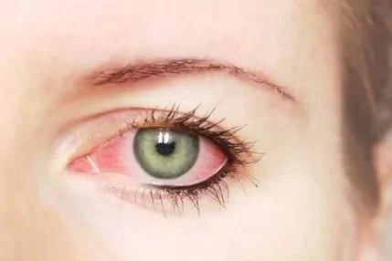 玻璃體混濁 玻璃體混濁